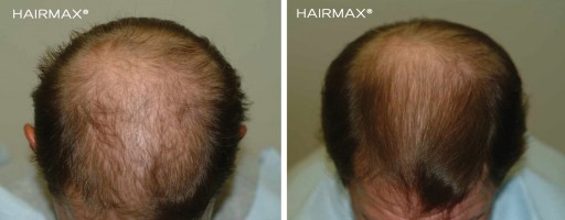 Лазерная расческа Hairmax Ultima12 для домашнего использования, для роста волос FDA